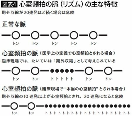 【図表4】心室頻拍の脈（リズム）の主な特徴
