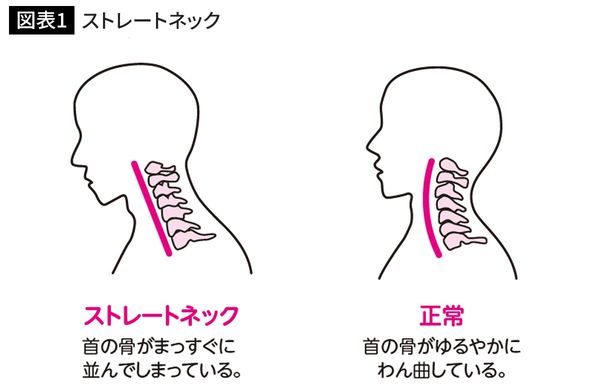 ストレートネック