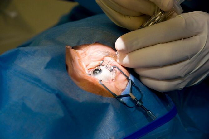 目の手術