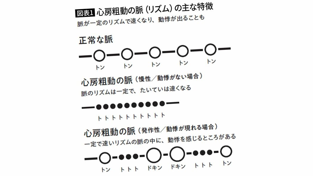 ｢トン-トン-トトトトトト｣と脈が速くなる…医師｢早く病院へ｣､最悪の場合は突然死に至る｢不整脈のリズム｣