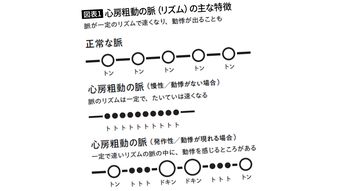 ｢トン-トン-トトトトトト｣と脈が速くなる…医師｢早く病院へ｣､最悪の場合は突然死に至る｢不整脈のリズム｣