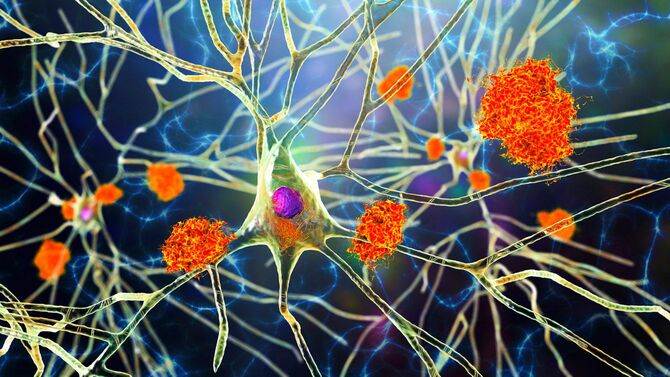 アルツハイマー病のニューロン、脳組織におけるアミロイドプラークのイメージ