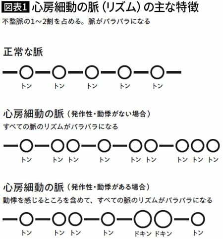 【図表1】心房細動の脈(リズム)の主な特徴