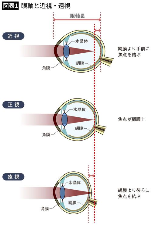 【図表1】眼軸と近視・遠視
