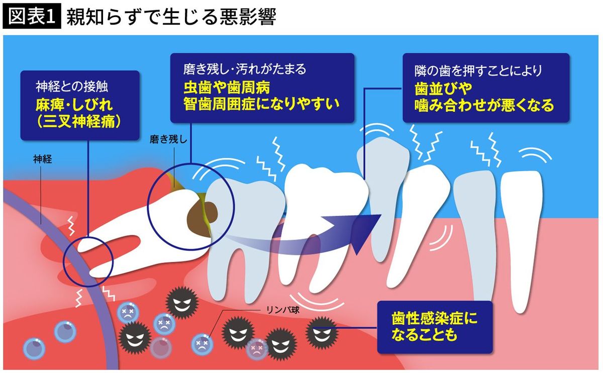 【図表1】親知らずで生じる悪影響