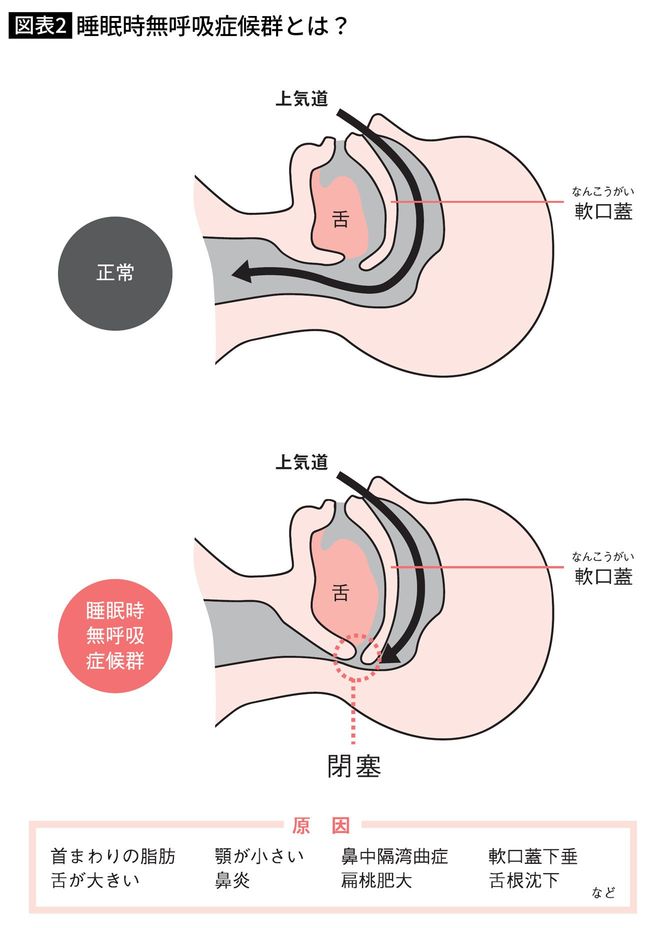 睡眠時無呼吸症候群とは？