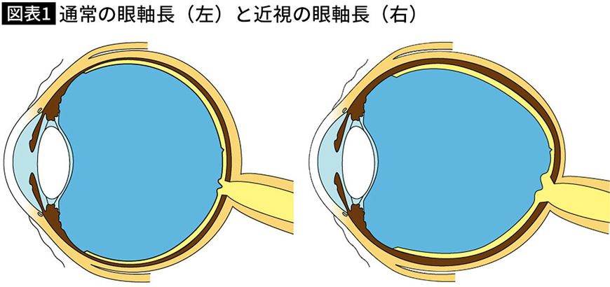 【図表】通常の眼軸長（左）と近視の眼軸長（右）