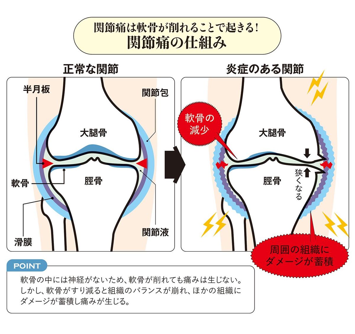 関節痛は軟骨が削れることで起きる！　関節痛の仕組み