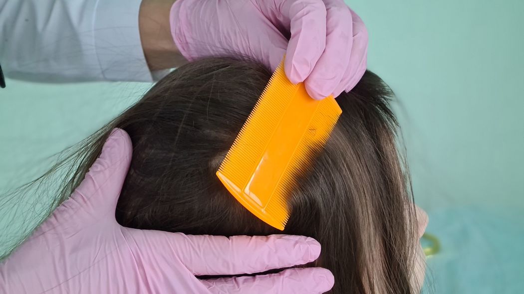 ｢不潔だから…｣アタマジラミの大誤解　｢あの子と遊ぶな｣で村八分､幼稚園で犯人捜しの悲しみ どんな人の毛髪にもアタマジラミはつく可能性がある