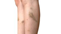 膵臓全摘後､肝臓と骨にがん転移…激痛に耐えながら出社する50代夫の脚に無数のアザができた悲しい理由