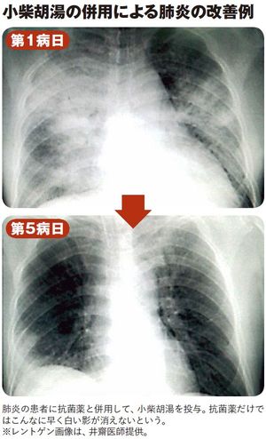 小柴胡湯の併用による肺炎の改善例