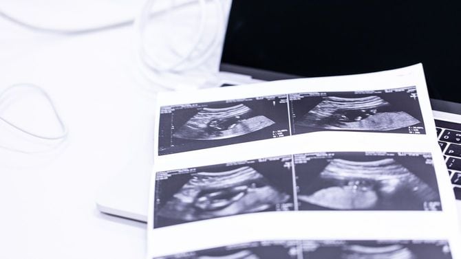 赤ちゃんの超音波