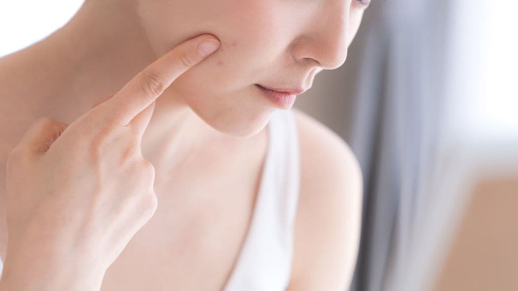 ｢ニキビは潰したほうが早く治る｣は半分ホント…皮膚科医が解説｢洗顔料､飲み薬､ニキビ跡｣の最新知識 専用針で膿を出したほうがいいケースもある