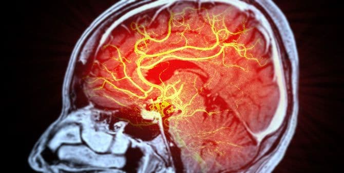 血管造影法を用いた脳の血管の医療画像診断