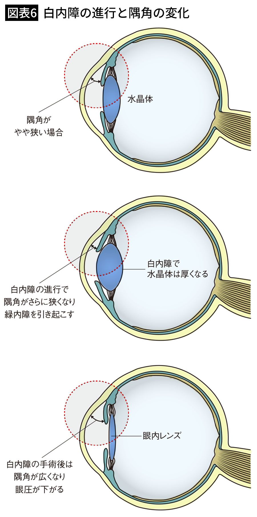【図表6】白内障の進行と隅角の変化