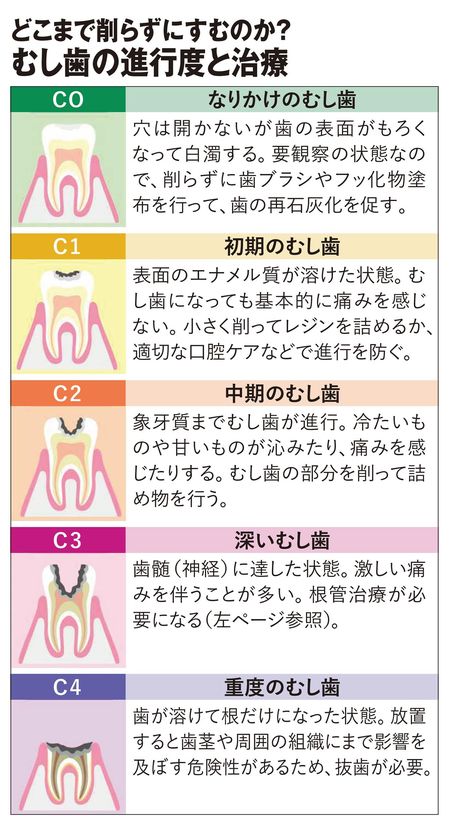 【図表】むし歯の進行度と治療