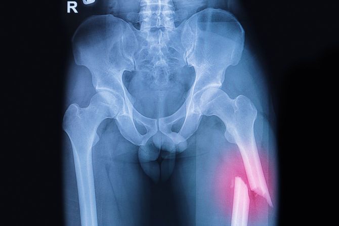 大腿骨骨折のX線画像