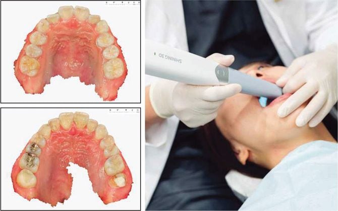 高性能な機種では、ほんの数分間で上下顎のスキャンが完了。患者にとっても、自分の口の中を子細に観察できるのは貴重な体験だ。