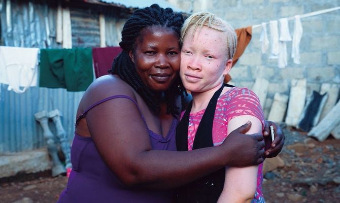 アフリカ・シエラレオネに住む、アルビニズムのサロミ(右)と母のアリス