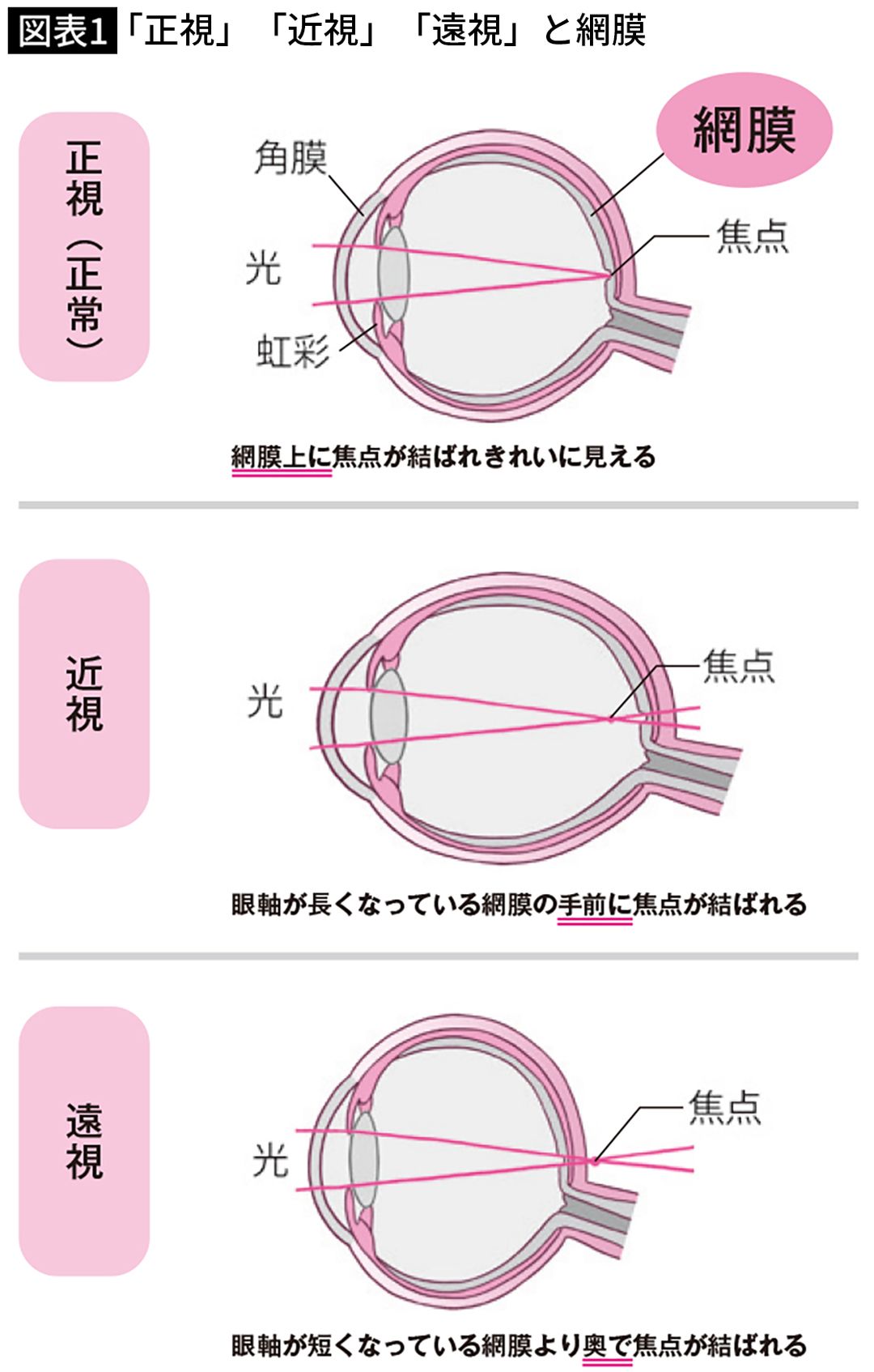 【図表】「正視」「近視」「遠視」と網膜
