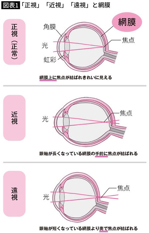 【図表】「正視」「近視」「遠視」と網膜