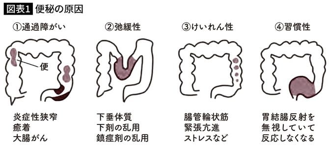 便秘の原因