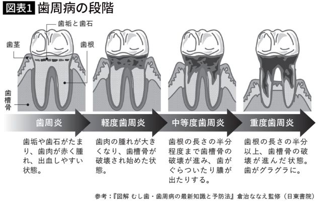 歯周病の段階