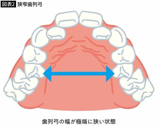 【図表2】狭窄歯列弓