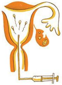 人工授精のイラスト