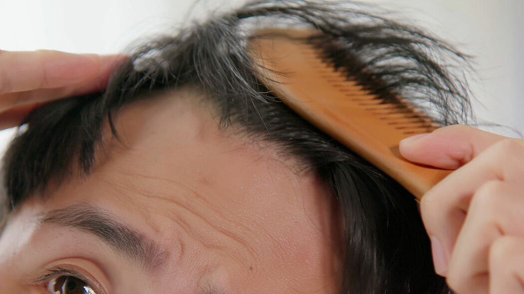 ヘルシーに見えて､｢薄毛｣リスクが上昇…専門医が｢血流の大敵｣と名指しする日本人が大好きな”白い食べ物”