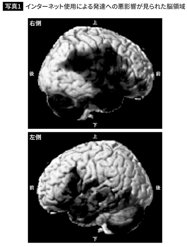 インターネット使用による発達への悪影響が見られた脳領域