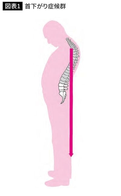 首下がり症候群