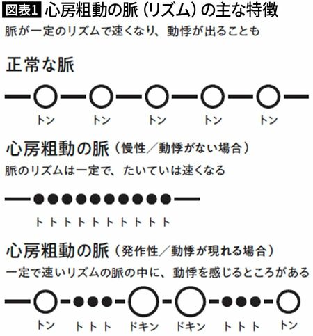 【図表1】心房粗動の脈（リズム）の主な特徴