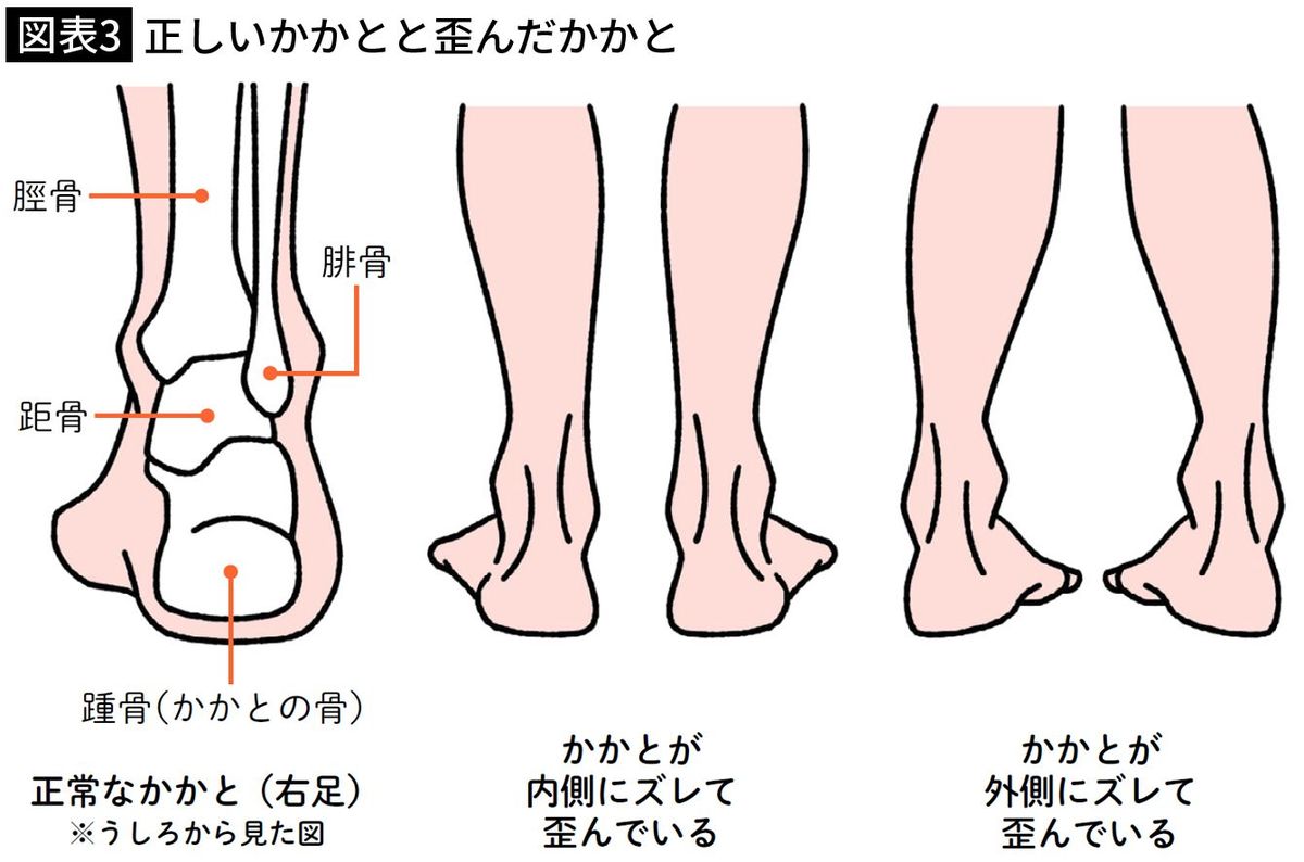 【図表3】正しいかかとと歪んだかかと