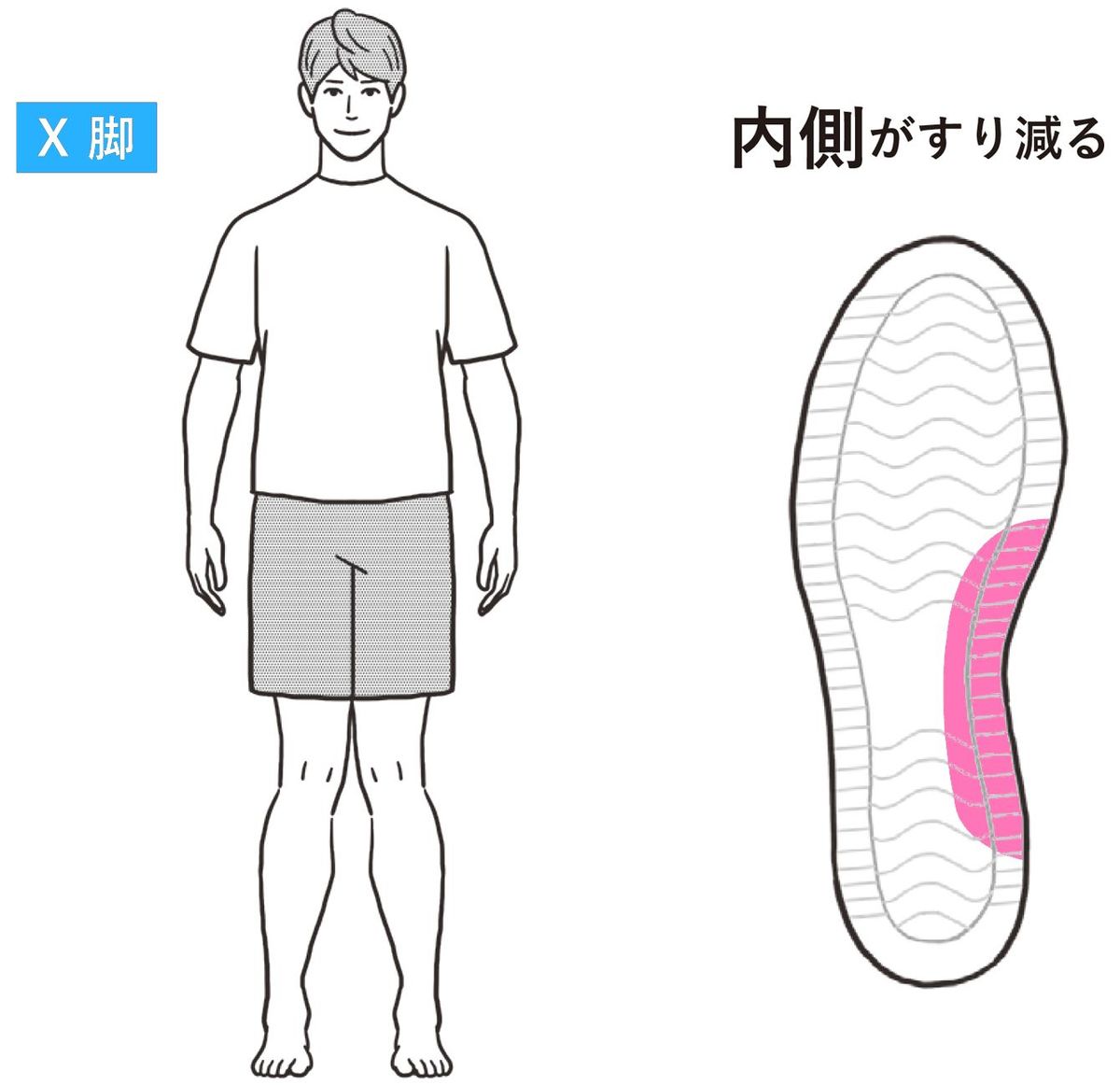 靴の内側がすり減る人はX脚