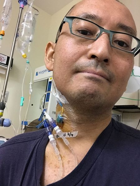 白血病の治療時、首にCVカテーテルを挿入される