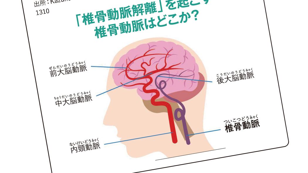 ｢高い枕｣でスマホは危ない…首の血管が裂ける脳卒中の意外なリスク