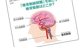 ｢高い枕｣でスマホは危ない…首の血管が裂ける脳卒中の意外なリスク