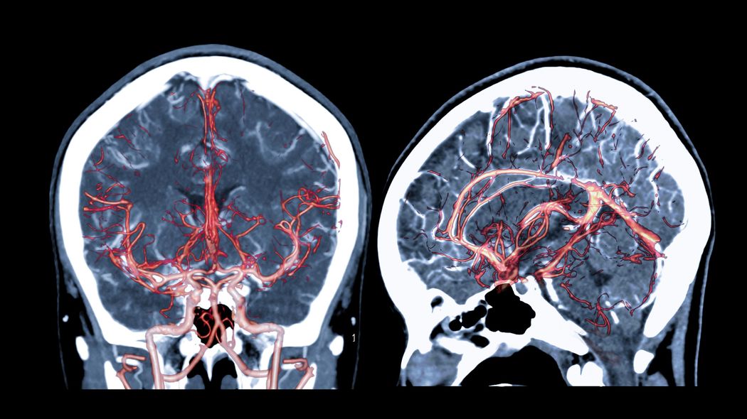｢裸のママが泣き叫んでる｣高3息子からのSOS…"健診オールA"でも大量に出血した脳画像を見た夫の絶望 医師に｢このまま妻を逝かせてあげて｣と懇願した理由